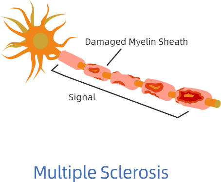 Multiple Sclerosis