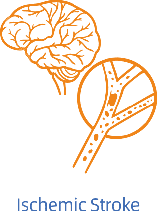 Ischemic Stroke