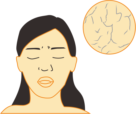 Синдром Шёгрена