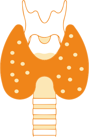 Гипертиреоз, болезнь Грейвса