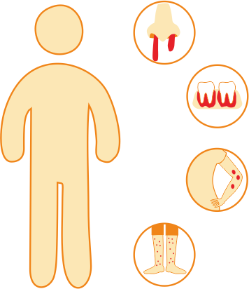 Иммунная тромбоцитопения