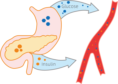 Сахарный диабет типа 1