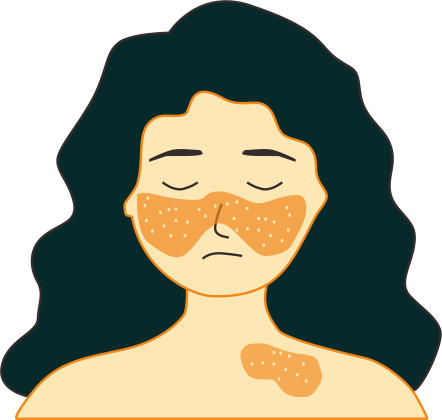 Системный красный лупус