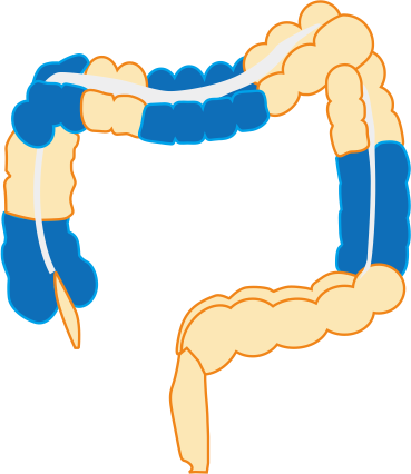 Язвенный колит