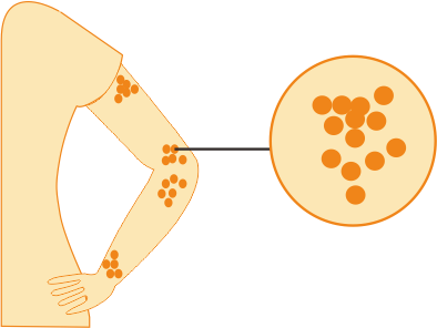 Идиопатические воспалительные миопатии