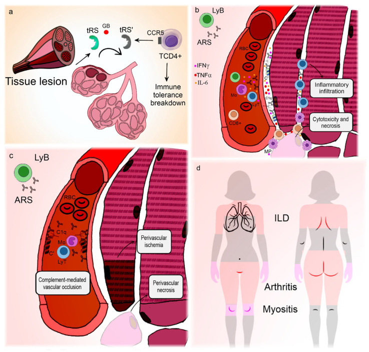 Pathogenesis and clinical manifestations of anti-synthetase syndrome