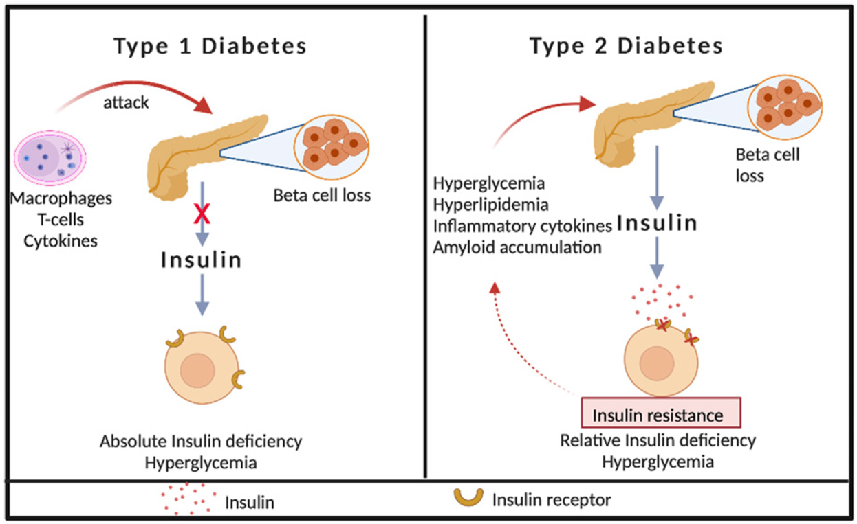 The process of genetic-environmental-immune interactions leading to β cell destruction