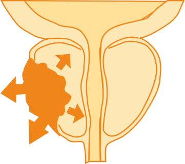 Рак предстательной железы