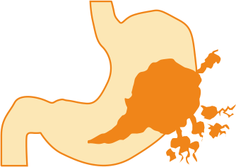 Рак желудка