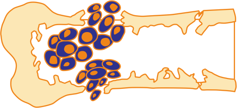 Множественная миелома