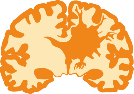 Глиобластома / Опухоли головного мозга