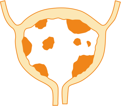 Рак мочевого пузыря