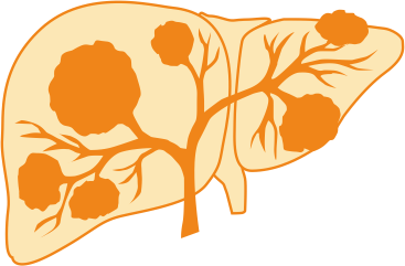 Гепатоцеллюлярная карцинома