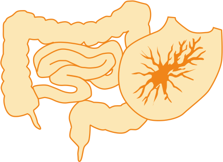 Колоректальный рак