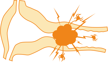 Рак шейки матки