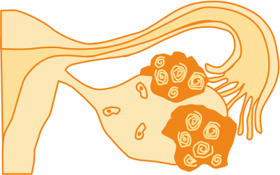 Рак яичников