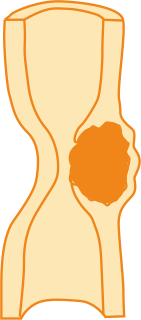 Рак пищевода