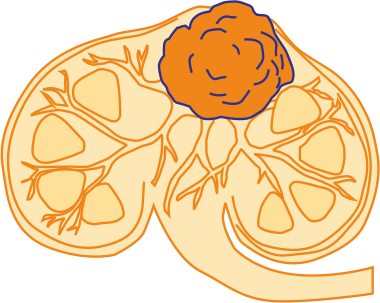 Почечно-клеточный рак