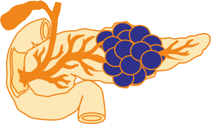 Рак поджелудочной железы